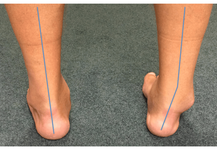 Clinical picture of patient with bilateral ankle arthritis worse in the right ankle, with obvious deformity at the ankle joint (blue lines)