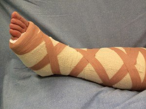 A backslab after foot and ankle surgery