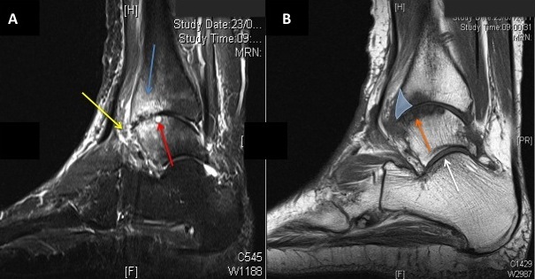 A - MRI of ankle arthritis, Reactive bone changes (blue arrow), synovitis (yellow arrow), subchondral cyst (yellow arrow)  B - MRI of ankle arthritis, anterior bone growth (shaded blue area) which results in anterior impingement and restricted movement, reactive bone changes (orange arrow), normal subtalar joint (white arrow)