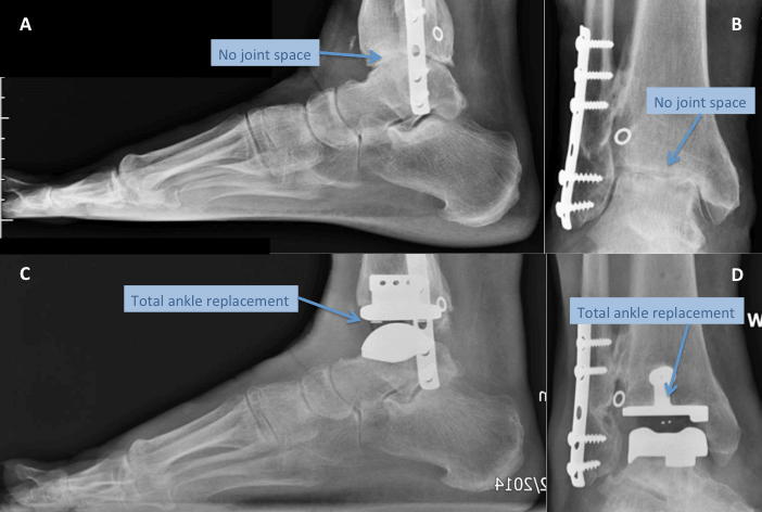 A + B Radiographs demonstrating post traumatic ankle arthritis C + D treated successfully with a total ankle replacement