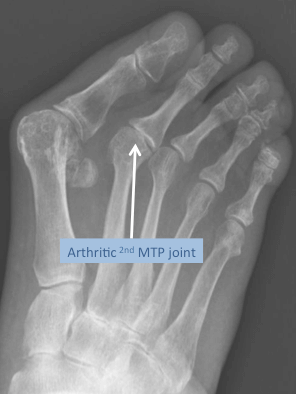 Radiograph (x-ray) of the foot, of a patient with a severe bunion deformity and 2nd MTP joint arthritis (note also has midfoot arthritis)