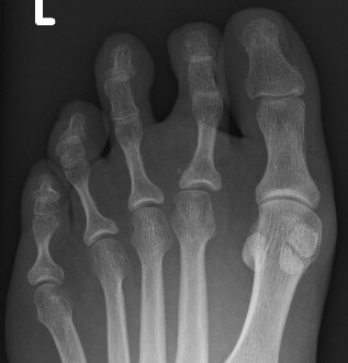 Radiograph of left foot demonstrating mild medial deviation of the 2nd MTP joint