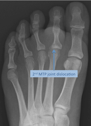 X-ray of the foot demonstrating dislocation of the 2nd MTP joint