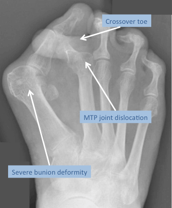X-ray of the foot in a patient with a severe bunion deformity complicated by 2nd MTP joint dislocation and resulting crossover toe deformity