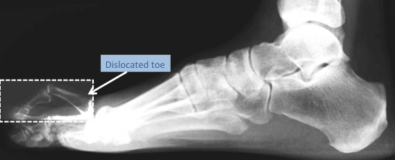 Lateral foot and ankle x-ray demonstrating 2nd toe dislocation at the MTP joint
