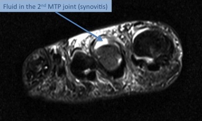 An MRI of the foot demonstrating inflammation (synovitis) in the 2nd MTP joint