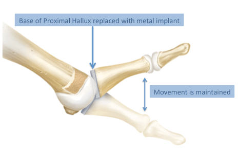 >Illustration demonstrating maintenance of range of motion at the 1st MTP joint following a hemiarthroplasty procedure