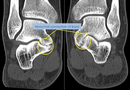 CT coronal view of both feet revealing fibrous talocalcaneal coalitions