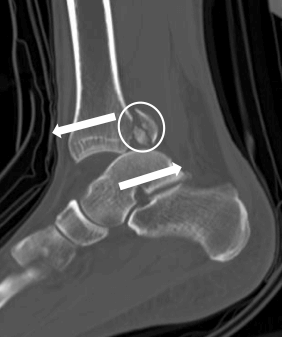 CT demonstrating subluxation of the ankle joint with posterior malleolar fracture fragment