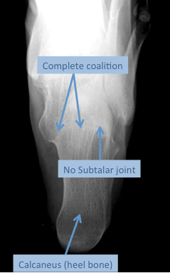 Harris radiographic view of the foot in a patient with complete talocalcaneal coalition