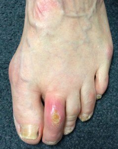 Infected ulcer on the dorsum of the toe caused by rubbing against shoes