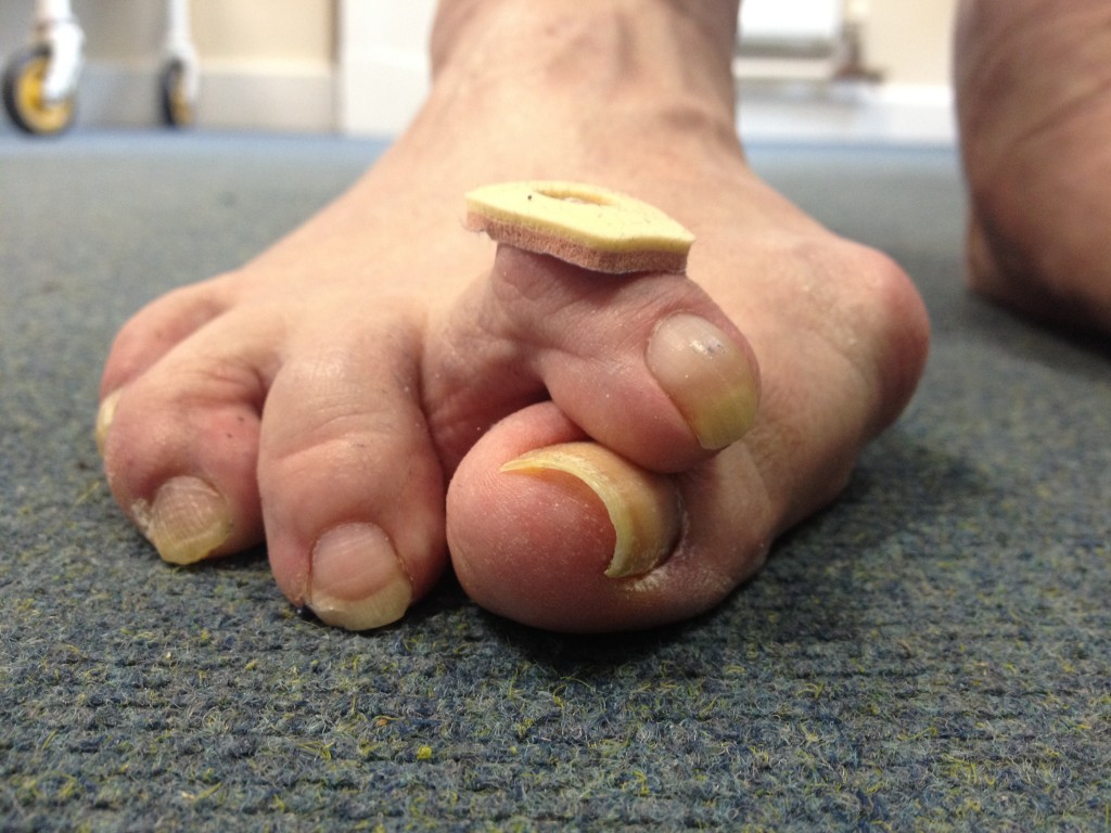 Often a patients main complaint is difficulty finding footwear that fits and pain where the 2nd toe rubs against shoes