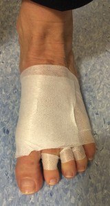 An example of taping around the foot to help maintain surgical correction and allow the foot structures to heal in the correct position