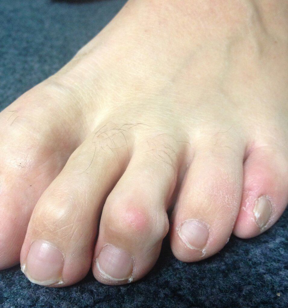 Mallet deformity of 2nd and 3rd toes