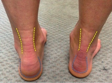 Clinical picture demonstrating features of insertional Achilles tendinopathy in the left foot with swelling of the distal Achilles tendon and bony enlargement at its insertion into the calcaneum
