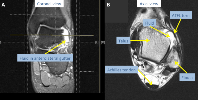 MRI of the ankle revealing a torn ATFL lateral ligament