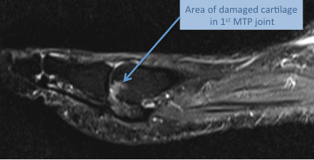 MRI of the big toe (1st MTP) joint demonstrating central area of damage to the cartilage