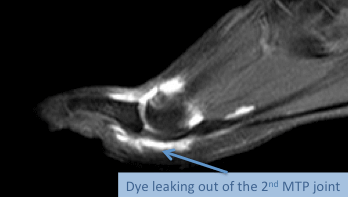MRI of the foot demonstrating leaking out of dye injected into the 2nd MTP joint indicating that there is a likely tear in the plantar plate and capsule