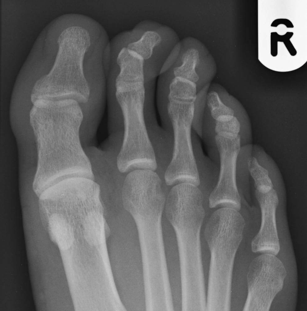Plain radiograph of mallet toe deformity of the 2nd toe