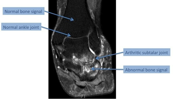 MRI revealing extensive arthritis of the subtalar joint