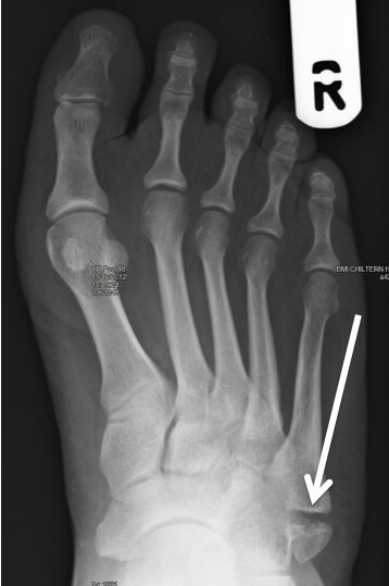 Displaced avulsion fracture at the base of the 5th metatarsal