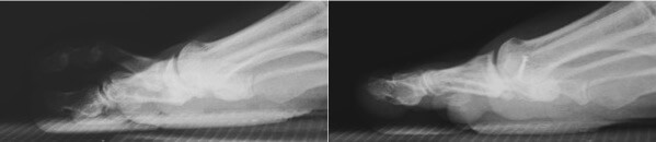 Before (left) and after (right) radiographs demonstrating a hammer deformity correction, note the 2nd toe is no longer elevated