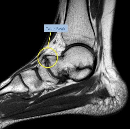 MRI of the hindfoot revealing talar beaking