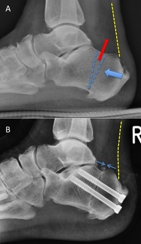 A - Zadeks calcaneal osteotomy involves removing a wedge of bone, the yellow dotted line represents the anterior border of the Achilles tendon B - Post Zadeks calcaneal osteotomy the superior calcaneal border is shortened (double blue arrow) and the Achilles tendon (yellow dotted line) is no longer under tension