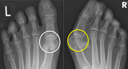 Radiograph of both feet in a patient with a bunion deformity on the right foot. Note the normal 1st MTP joint (white circle) on the left and the arthritic joint (yellow circle) on the right