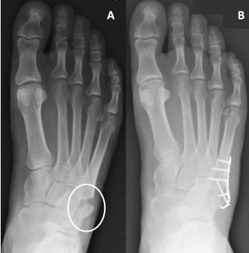 A - Displaced non union 5th metatarsal fracture B - a 5th metatarsal fracture successfully fixed with plate and screws