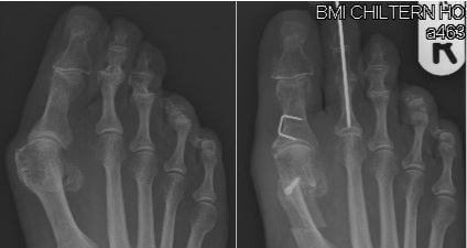 Before (left) and after (right) radiographs of a bunion and hammer toe deformity correction with temporary K-wire