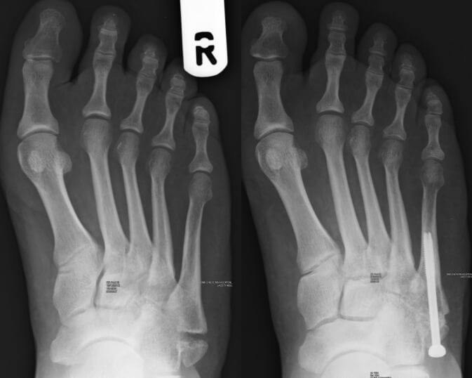 Before and after radiographs of a non-union avulsion base of 5th metatarsal fracture fixed with bone graft and screw