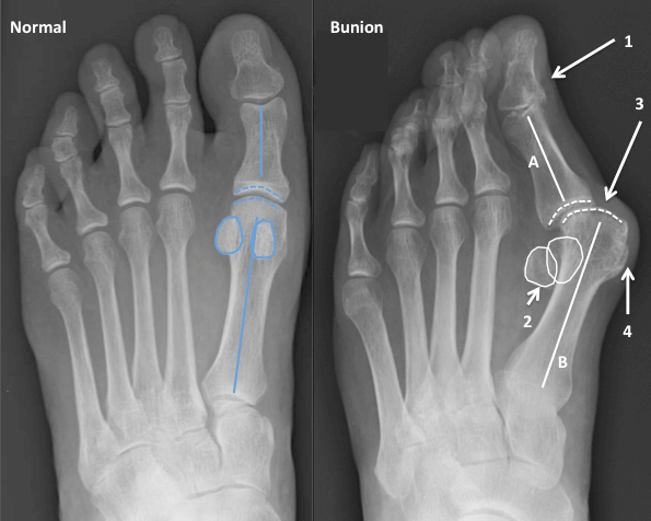 X-ray demonstrating the changes associated with a bunion compared to a normal foot. 1 - the big toe (hallux) turns on to its side, 2 - the sesamoid bones are no longer covered by the 1st metatarsal head, 3 - the 1st MTP joint is no longer congruent (when the two joint surfaces are properly aligned), 4 - prominent bump (medial eminence), A - the big toe (hallux) deviates laterally towards the lesser toes and displaces them, B - the 1st metatarsal deviates medially