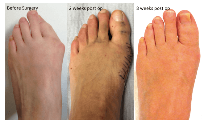 clinical picture before and after bunion