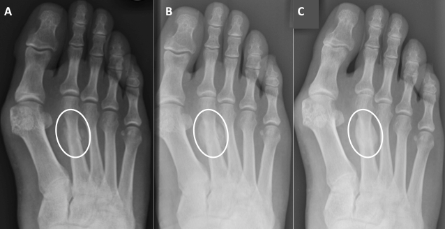 Serial radiographs of the foot demonstrating a 2nd metatarsal stress fracture in a patient with a hallux valgus deformity. The x-rays span a 3 months priod (from initial scan to recovery)