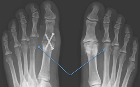 X-rays of both feet 8 weeks after successful left 1st MTP joint fusion - note the disuse osteopenia (this is a temporary effect of non weight bearing and the bone will return to normal strength)