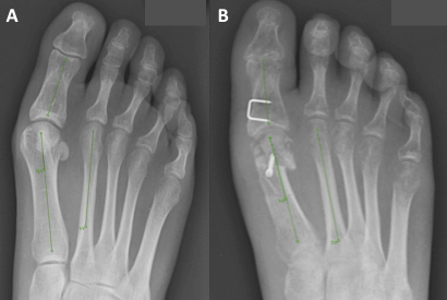 A - Before and B - After x-rays of the foot in a patient who has undergone bunion surgery, note the darker areas in the bone after surgery indicating disuse osteopenia