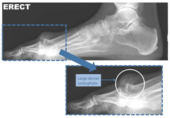 Radiograph (x-ray) of an arthritic big toe (1st MTP) joint with a massive growth of bone on the top of the joint (dorsal osteophyte)