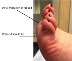 Clinical picture demonstrating the abnormal position of the plantar fat pad in a patient with clawed toes