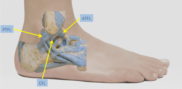 Lateral aspect of foot and ankle illustrating the 3 lateral ligaments, ATFL is the most commonly injured ligament in the foot and ankle