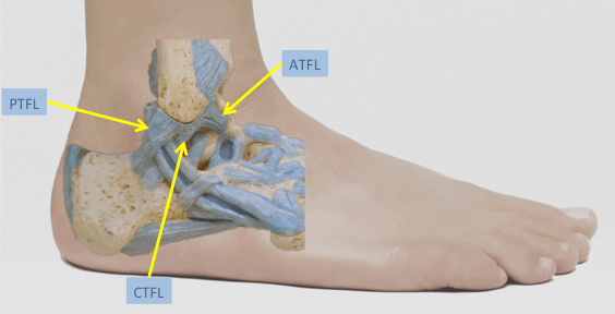 Lateral aspect of foot and ankle illustrating the 3 lateral ligaments. ATFL is the most commonly injured ligament in the ankle