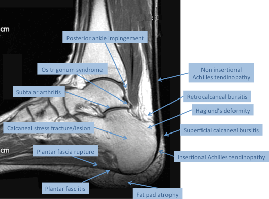 An MRI of the hindfoot and the common causes of heel pain - note the site of superficial calcaneal bursitis