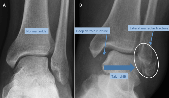 Ankle Fracture Types Treatment The London Foot Ankle Clinic Ankle Fracture Types Treatment The London Foot Ankle Clinic