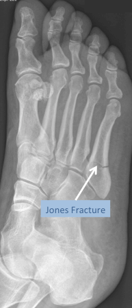 X-ray of the foot demonstrating a Jones fracture