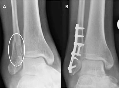 A - an x-ray of lateral malleoli fracture, B - an x-ray showing a fixed with plate and screws with anatomical reduction