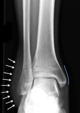 Radiograph of a sprained ankle demonstrating extensive soft tissue swelling on the lateral side (arrows), note normal soft tissue margin medially (blue line)