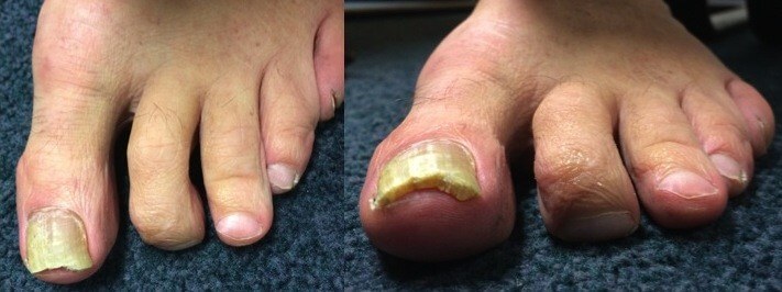 Longstanding mallet toe which is now a fixed deformity