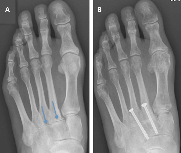 Radiograph of the foot - A is before and B is after with the 2nd and 3rd TMT joint fusion (blue arrows indicate the arthritic joints)
