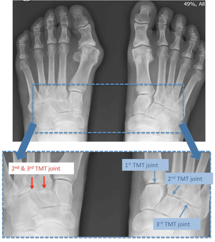Plain radiograph (x-ray) of both feet showing a normal right foot and and an arthritic left foot involving the left 2nd and 3rd TMT joints. Note the decreased joint space indicating loss of normal cartilage in the joint