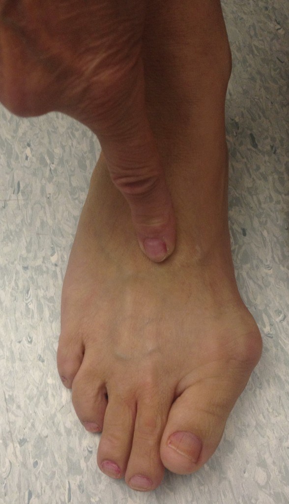 A patient with painful 2nd TMT joint arthritis which developed as a result of her bunion (hallux valgus) deformity